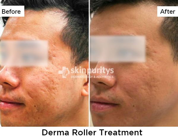 Derma Roller results